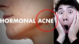 HOW TO HEAL HORMONAL ACNE (By the Healthy Skin Coach & Biohacker)