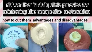 Ribbon fibre composite restoration in daily clinic practice 