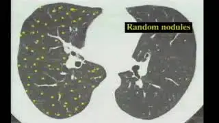 HRCT CHEST   LUNG AND NODULES