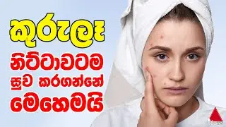 කුරුලෑ නිට්ටාවටම සුව කරගන්නේ මෙහෙමයි | JWID | Nirogi | Sirasa TV