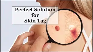 Skin Tags Treatment - Dr. Rohit goel ( DTC skin clinic, Ayurskinclinic, GIADA)