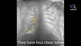 Clinical Case: Spectral Dual-Energy X-ray Reveals ICU Pneumothorax and Line Placement