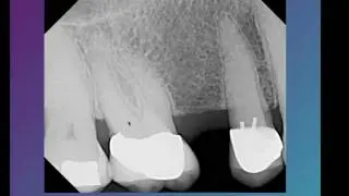 Why Cone Beam CT Is Important for Your Root Canal Treatment