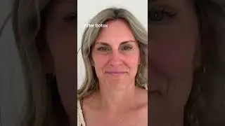 See the difference: Botox Before & After