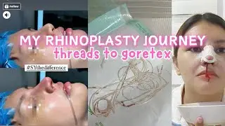 I DID IT! Hiko Threads to Goretex Rhinoplasty | Doctor, Price, Experience | Karenn C.