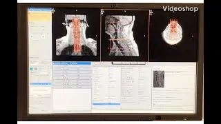 MRI Spine set up Part 2 - Week 6
