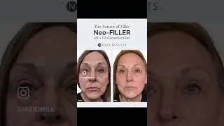 Ditch the Pricks, you will not miss Botox #botoxfree #ditchthepricks #linktoorderinprofile