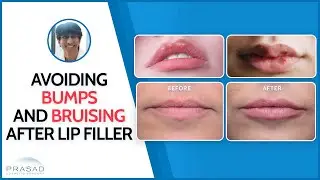 Avoiding Bumps After Lip Filler, and Bruising #lipfillers