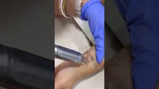 From ink to clear skin #tattoo #tattooremoval