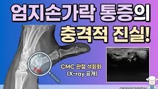 엄지 손목 통증의 범인, 초음파로 직접 확인한 석회화! | Ultrasound Diagnosis for Thumb CMC Joint Calcification 🦴