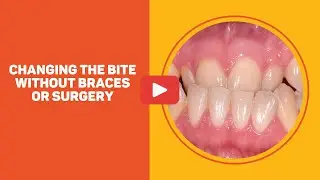 Underbite - Changing the bite WITHOUT Braces or Surgery