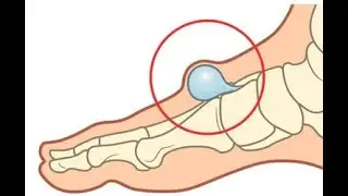 Benign or malignant Bony Lumps; growth pattern, radiological features, and clinical presentation