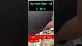 Rupture of urinary bladder l Retention of urine l Dr umar khan