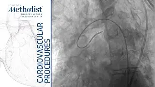 Reforming a Sim 1 Catheter (Alan B. Lumsden, MD)