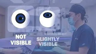Is LASIK / SMILE Safe? The Hidden Risk of Corneal Dystrophy  - Acuitylab Refractive Genetic Test
