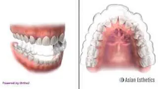 Clear Removable Appliance