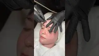 ASMR Rapid Resurface🧖🏼&zwj;♀️ #smoothskin #vibrantskin Microdermabrasion + Peel