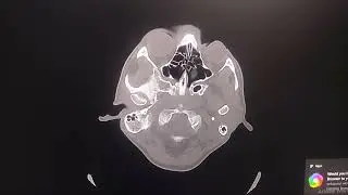 Normal Ct scan Head