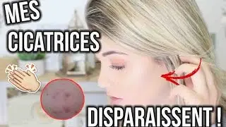 MES CICATRICES DISPARAISSENT !
