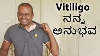 Vitiligo My Experience World Vitiligo Day ವಿಟಿಲ್&zwj;ಗೋ-ತೊನ್ನು ಹಾಲ್ಚರ್ಮ ಬಿಳಿ ಮಚ್ಚೆ