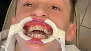 Bridger Gets Braces, Prepping for an Expander