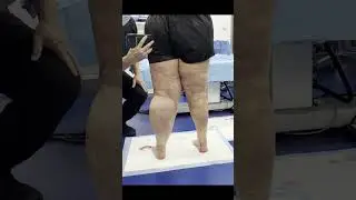 Leg Lipo Results #shorts #lipedema #liposuction #weightloss #beforeandafter #weightlossjourney