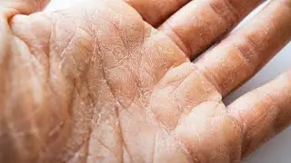 Dry Hands| Top 5 Moisturizing Remedies You Need to Try Now