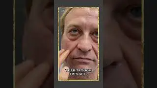 Facelift For Men - Male Ponytail Facelift Pre-op  #beforeandafter #facelift