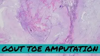 Gout in Bone (Toe Amputation for Gout plus possible osteomyelitis) pathology podiatry orthopedics