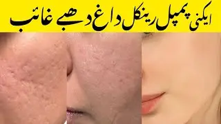 Anti Acne serum review | wrinkle treatment | Age spot treatment | dark circles treatment