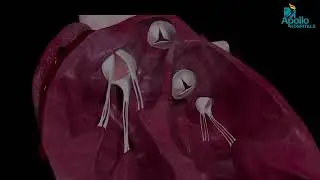 What Is Heart Valve Repair? | Doctor Explains Simply