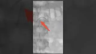 Varicocele embolization live case - Step 3 | Dr. Gaurav Gangwani