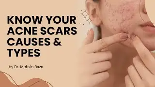 Causes and Types of Acne Scars | Explained by Dermatologist Dr. Mohsin Raza