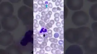 May-Hegglin anomaly (D&ouml;hle body like inclusions & giant platelets) peripheral blood smear hematology