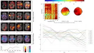 Tinnitus, Brain Networks & Bisensory Neuromodulation Results — Separating Loudness from Distress