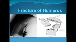 Fracture of humerus (Proximal end and shaft)