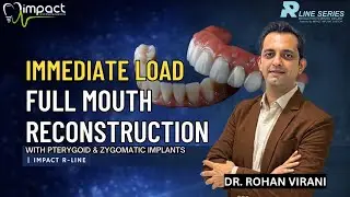 Immediate Load Full Mouth Reconstruction with Pterygoid & Zygomatic Implants | Dr. Rohan Virani
