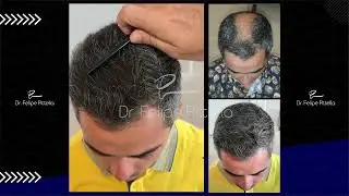 FUE - Dr. Pittella &bull; Large bald Area, Thick hair: SOLVED